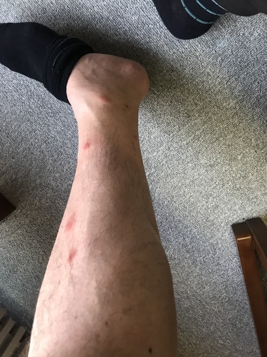藪蚊に刺され悲惨な足